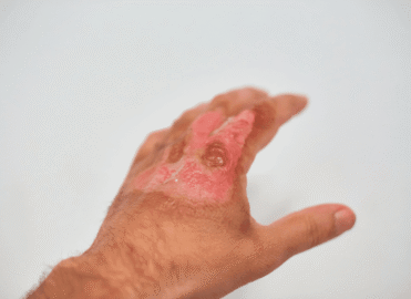 Best Burn Contracture Surgery in Dhaka | Safe Scar Release & Skin Restoration