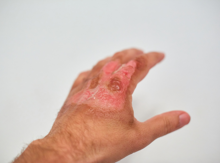 Best Burn Contracture Surgery in Dhaka | Safe Scar Release & Skin Restoration