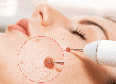 Best Mole Removal in Dhaka | Safe & Professional Skin Treatment