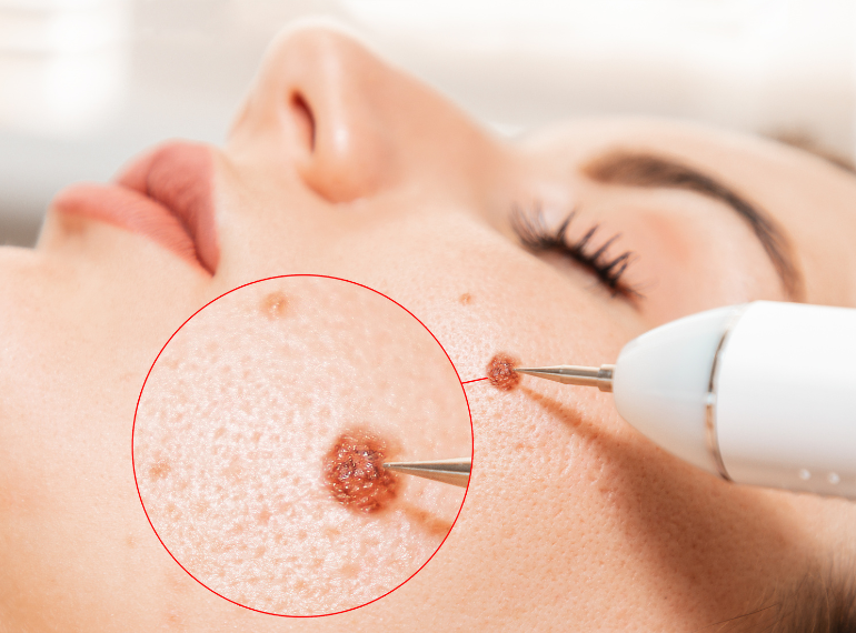 Best Mole Removal in Dhaka | Safe & Professional Skin Treatment