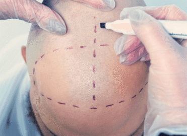 Best Hair Transplant in Dhaka | Safe & Natural Hair Restoration