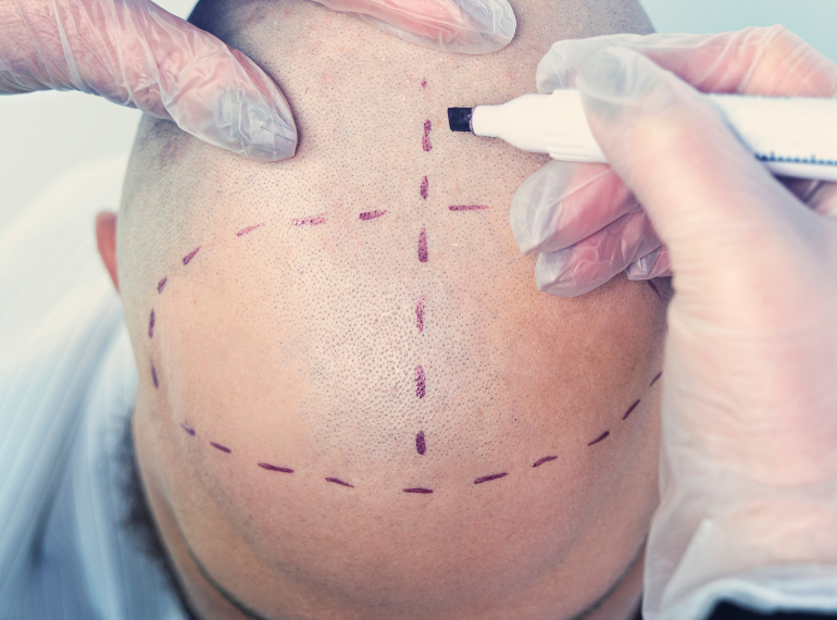 Best Hair Transplant in Dhaka | Safe & Natural Hair Restoration