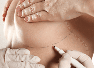 Best Mammoplasty in Dhaka | Breast Reduction & Augmentation
