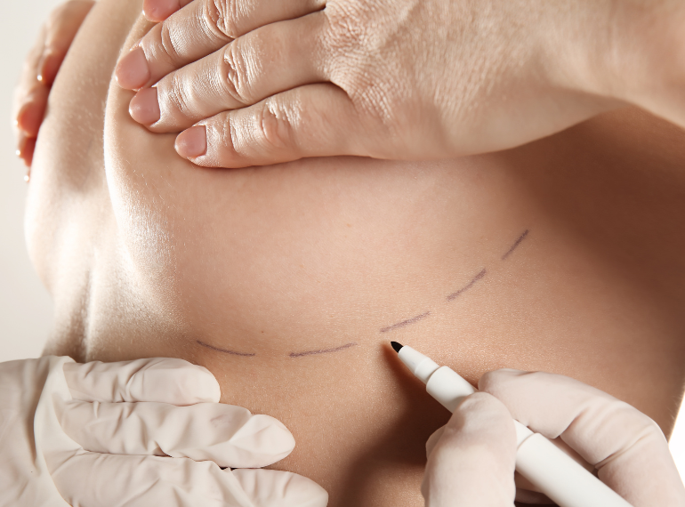Best Mammoplasty in Dhaka | Breast Reduction & Augmentation