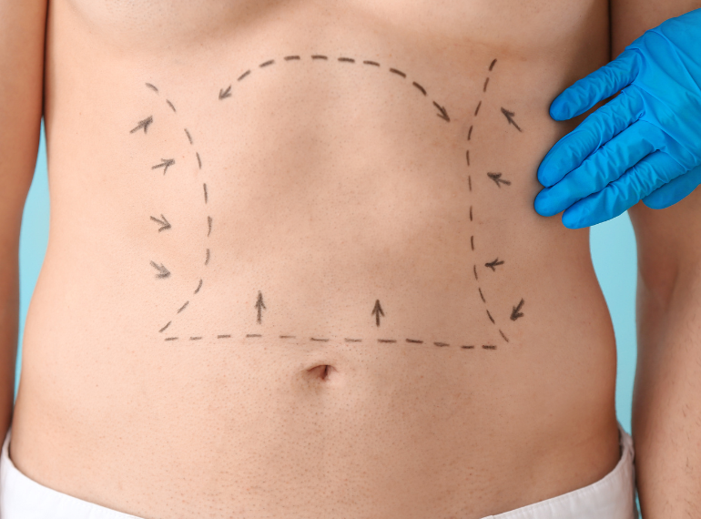 Best Abdominoplasty in Dhaka | Safe Tummy Tuck & Flat Belly