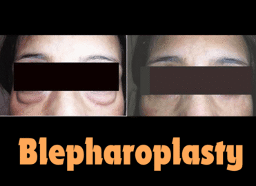 Blepharoplasty Surgery – Eyelid Lift Procedure Overview