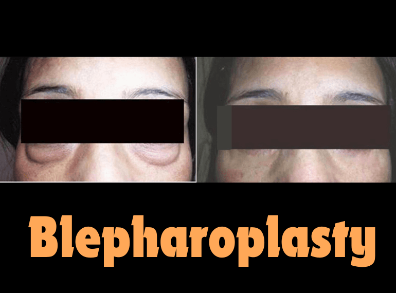 Blepharoplasty Surgery – Eyelid Lift Procedure Overview
