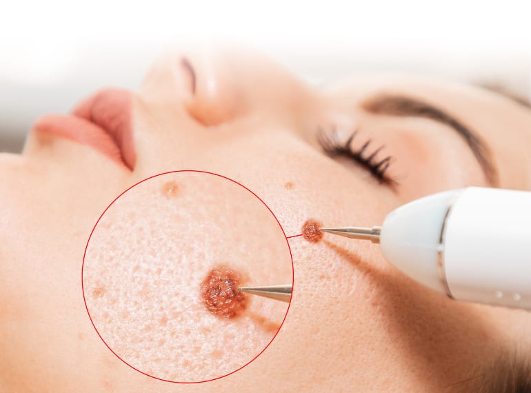 Acne Scar Treatment Dhaka Clinic